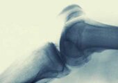 knee pain